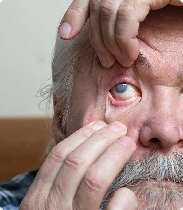 Understanding Pediatric Cataracts